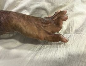Rashimi's hand also suffered burn damage.