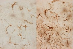 Microscopic imagery of healthy brain cells (left) and septic brain cells affected by Alzheimer’s (right) show how the disorders can dramatically alter the brain.