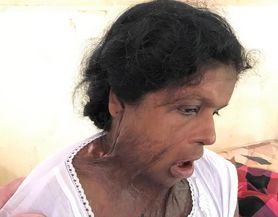 Rashimi, a domestic abuse victim, has face and neck scars from a domestic abuse incident.